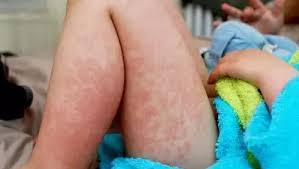 Mold Toxicity in Children